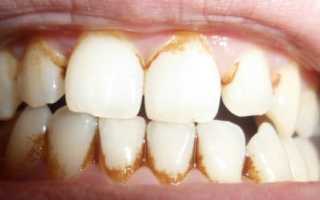 Коричневые пятна на зубах: почему появляются точки и полоски, и как убрать