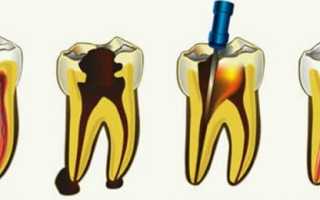 Сколько живет зуб без нерва после удаления и что с ним происходит